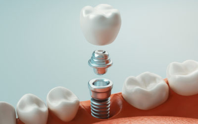 7 Rewarding Benefits of Dental Implants